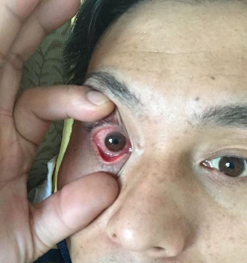 探究眼睛红肿的原因（揭开红眼背后的真相）