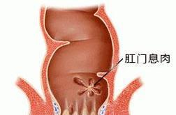 肛门旁边红肿的原因及处理方法（揭秘肛门旁边红肿的真相，有效缓解不适）
