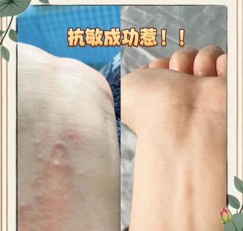 养猫者如何应对猫毛过敏？（解决猫毛过敏困扰的实用方法）