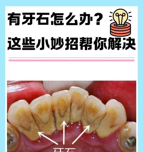 如何处理猫的牙结石和牙龈炎？（解决猫的口腔问题，让它们拥有健康的牙齿和牙龈）